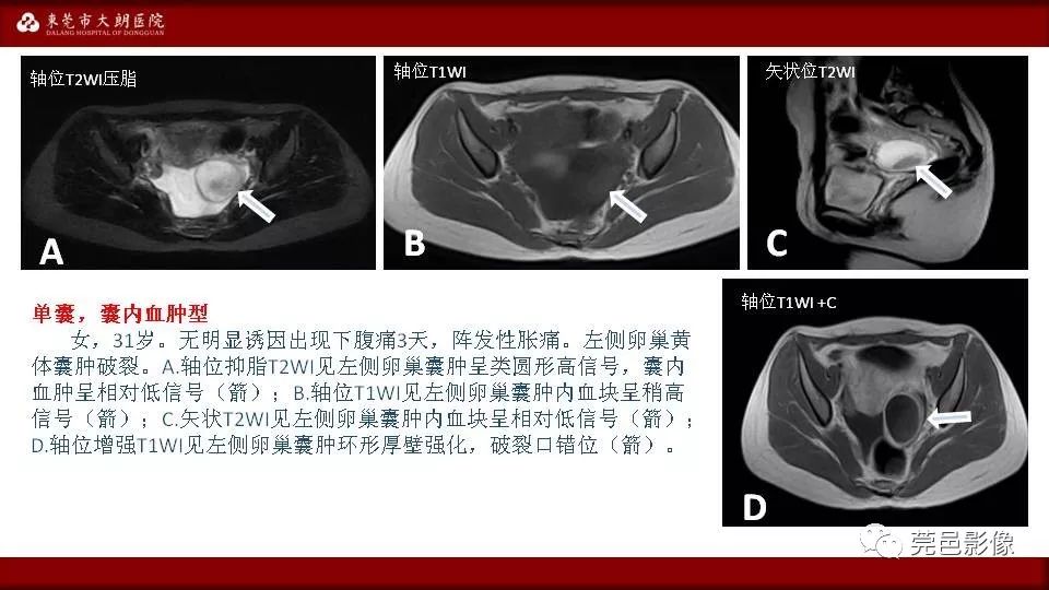 【PPT】MRI诊断卵巢黄体囊肿破裂