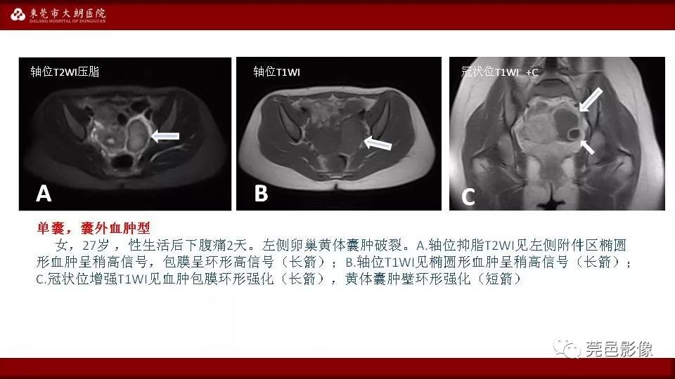 【PPT】MRI诊断卵巢黄体囊肿破裂