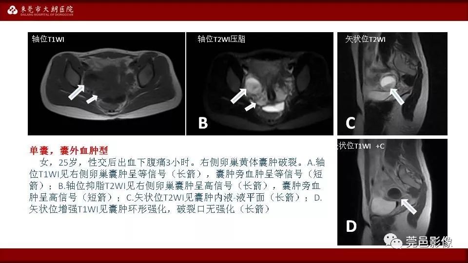 【PPT】MRI诊断卵巢黄体囊肿破裂