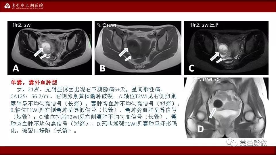 【PPT】MRI诊断卵巢黄体囊肿破裂