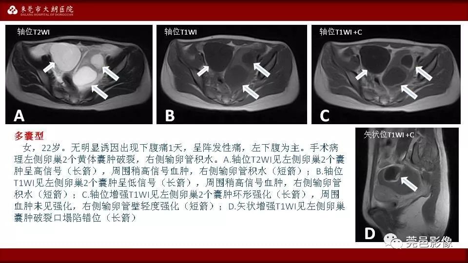 【PPT】MRI诊断卵巢黄体囊肿破裂