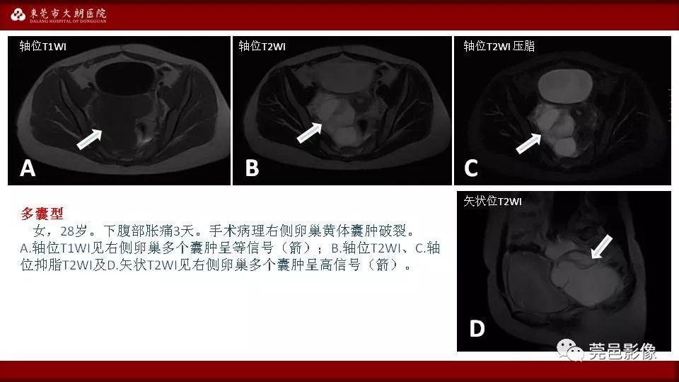 【PPT】MRI诊断卵巢黄体囊肿破裂