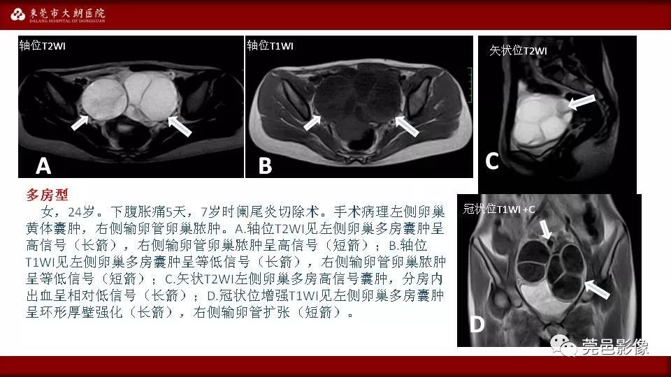 【PPT】MRI诊断卵巢黄体囊肿破裂