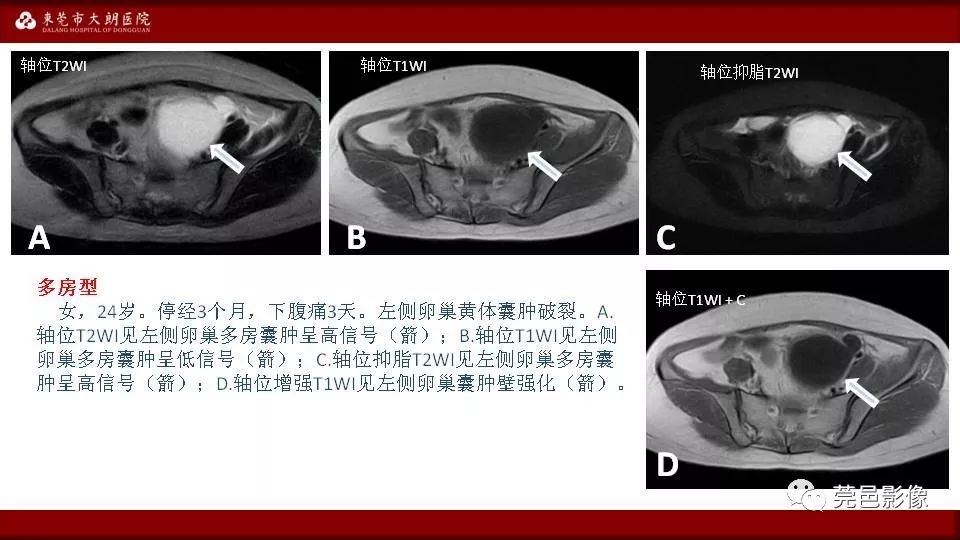 【PPT】MRI诊断卵巢黄体囊肿破裂