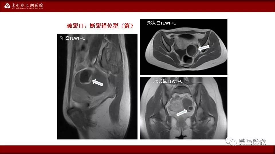 【PPT】MRI诊断卵巢黄体囊肿破裂