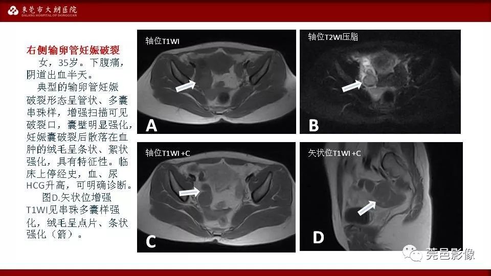 【PPT】MRI诊断卵巢黄体囊肿破裂