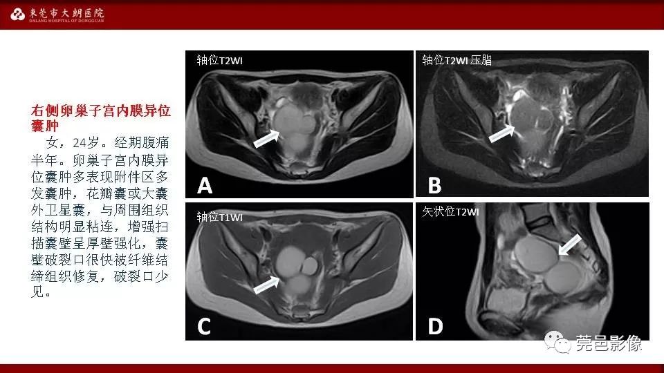 【PPT】MRI诊断卵巢黄体囊肿破裂