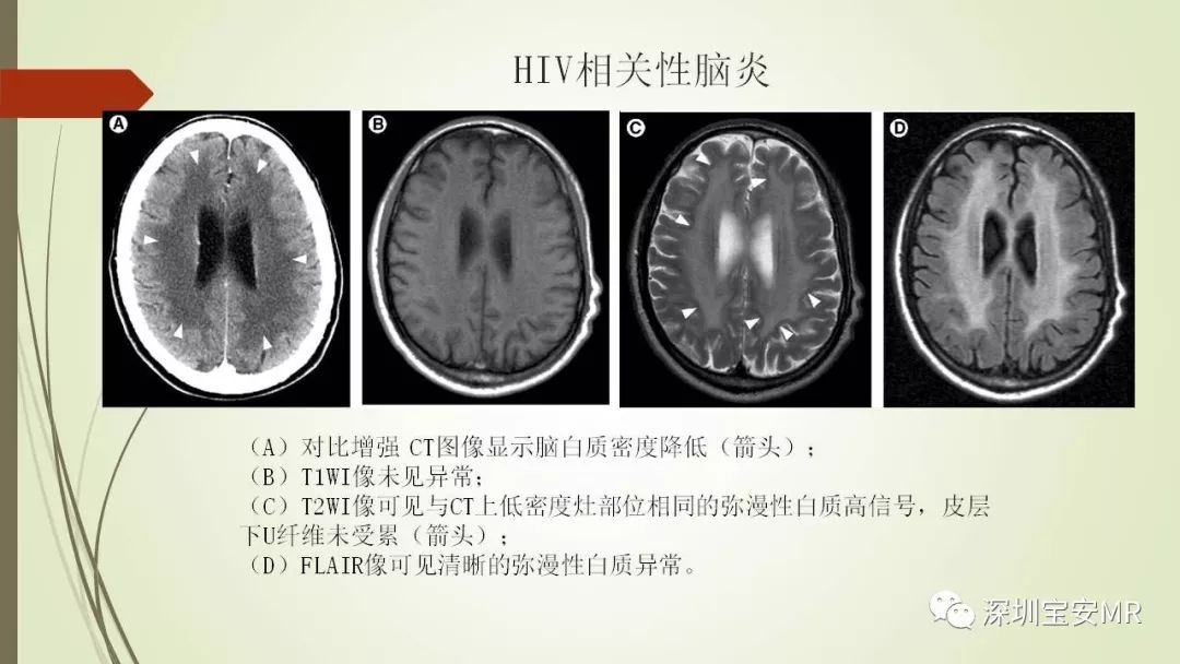【PPT】病毒性脑炎的影像表现