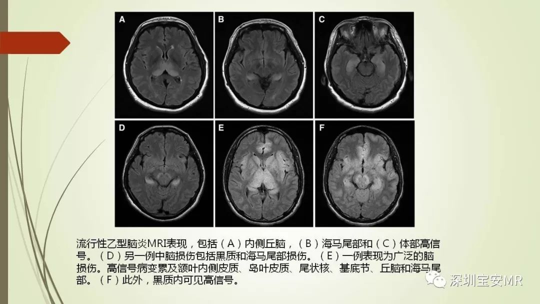 【PPT】病毒性脑炎的影像表现