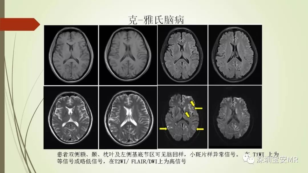 【PPT】病毒性脑炎的影像表现