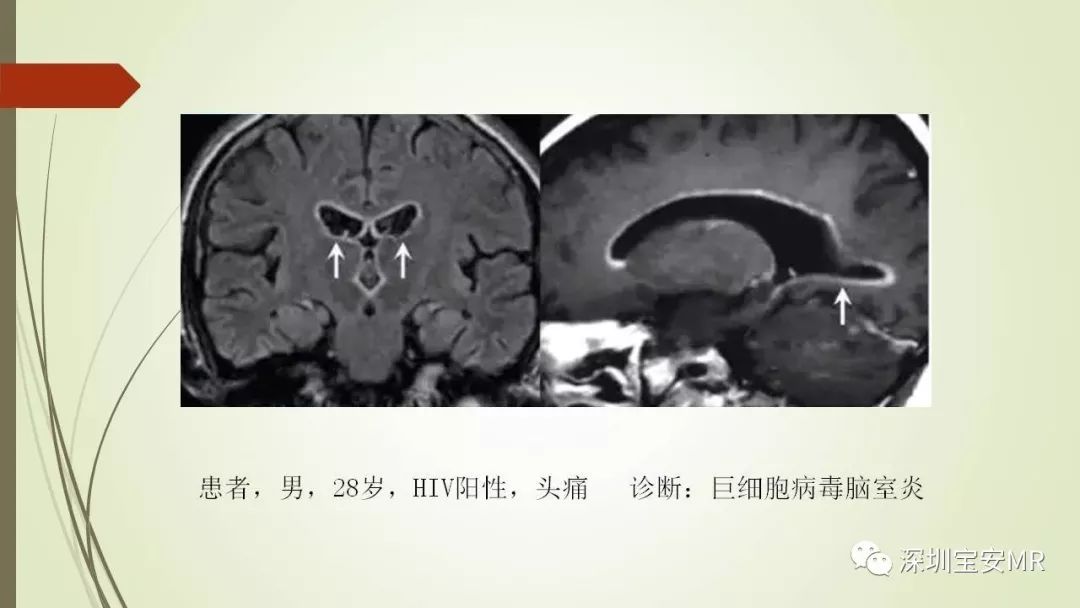 【PPT】病毒性脑炎的影像表现