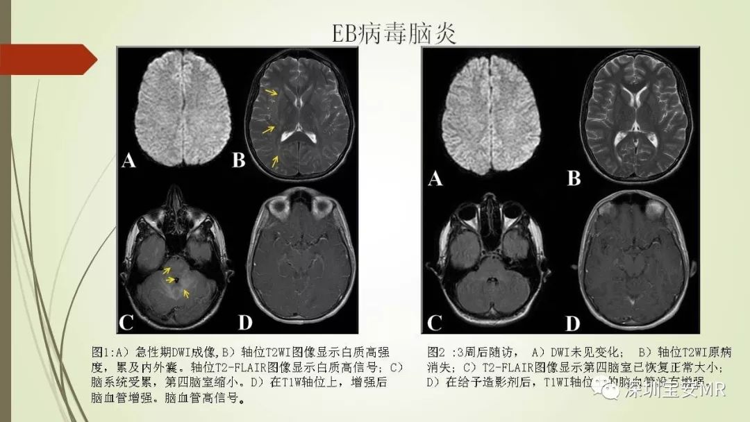 【PPT】病毒性脑炎的影像表现