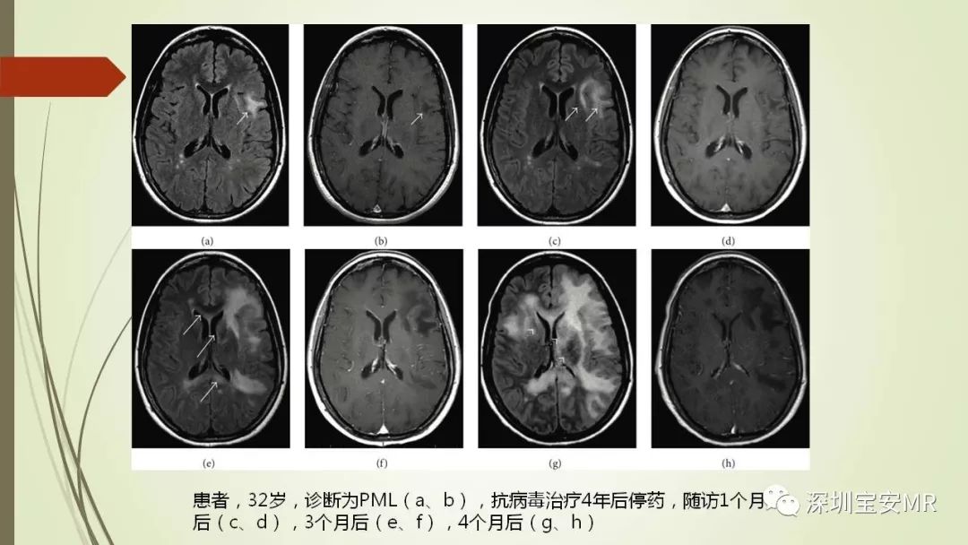 【PPT】病毒性脑炎的影像表现