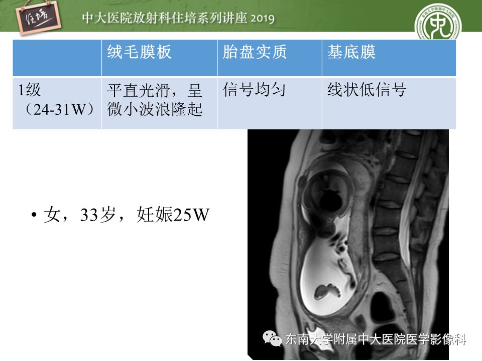【PPT】胎盘相关MR诊断