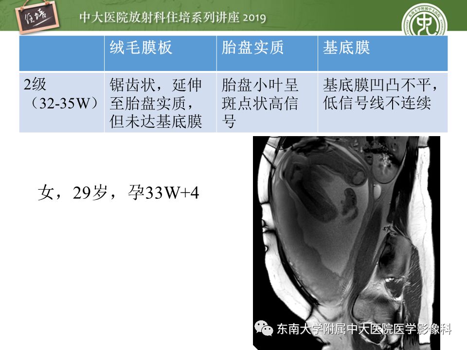 【PPT】胎盘相关MR诊断