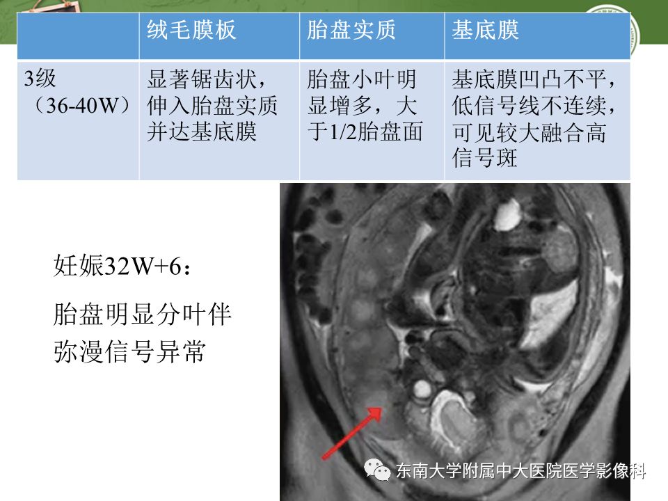【PPT】胎盘相关MR诊断