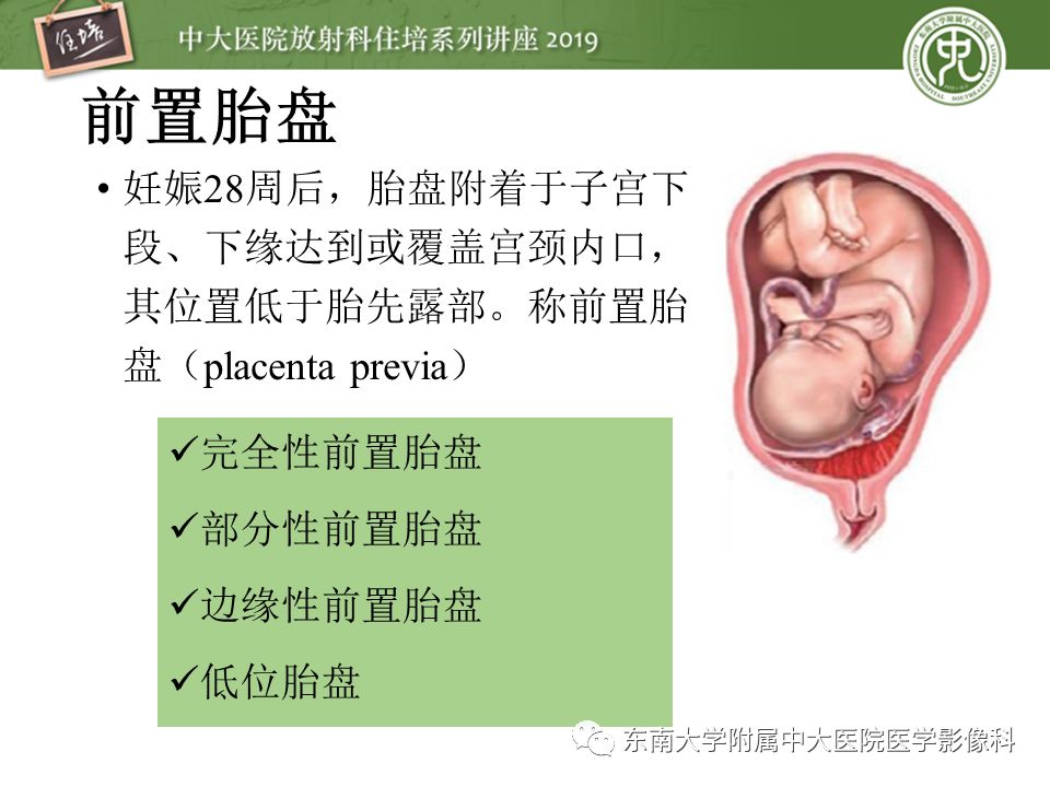 【PPT】胎盘相关MR诊断