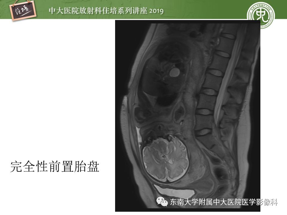 【PPT】胎盘相关MR诊断