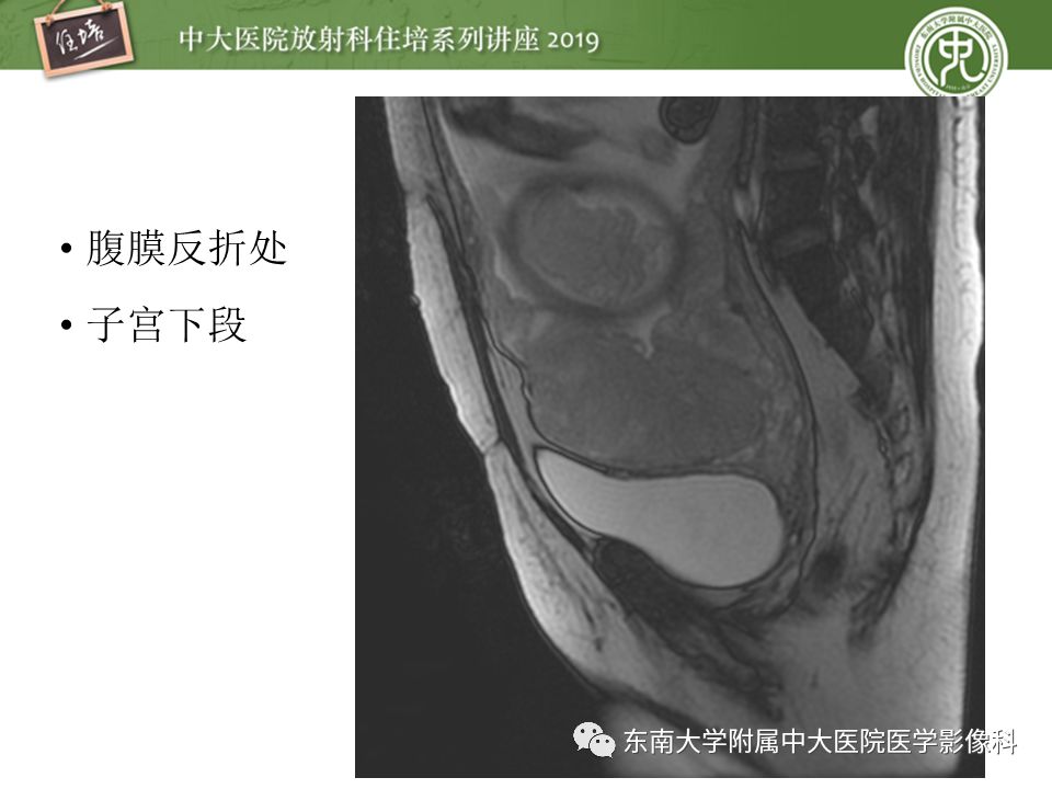 【PPT】胎盘相关MR诊断