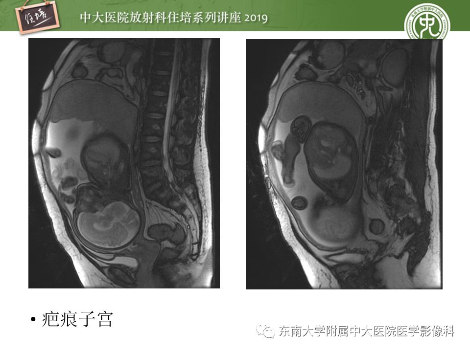 【PPT】胎盘相关MR诊断
