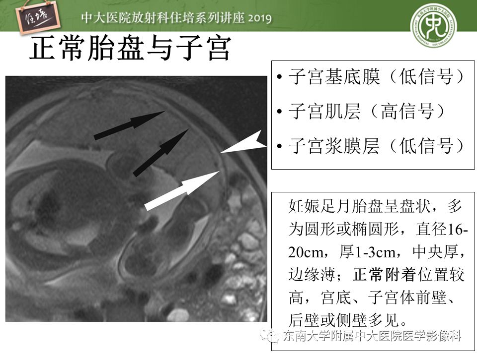 【PPT】胎盘相关MR诊断