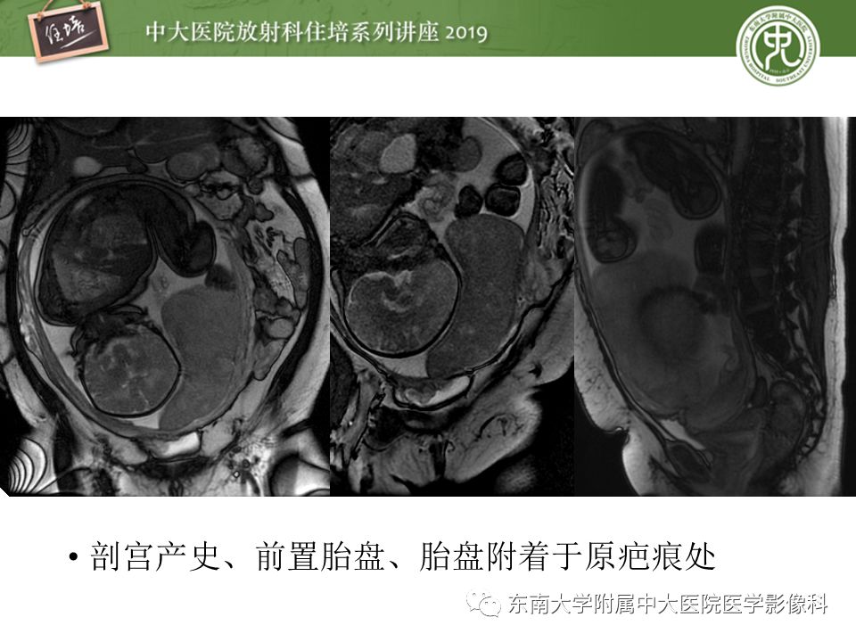 【PPT】胎盘相关MR诊断