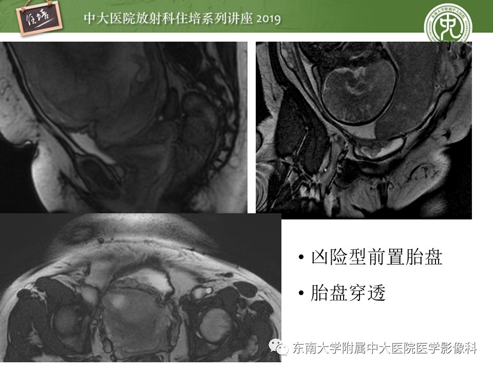 【PPT】胎盘相关MR诊断