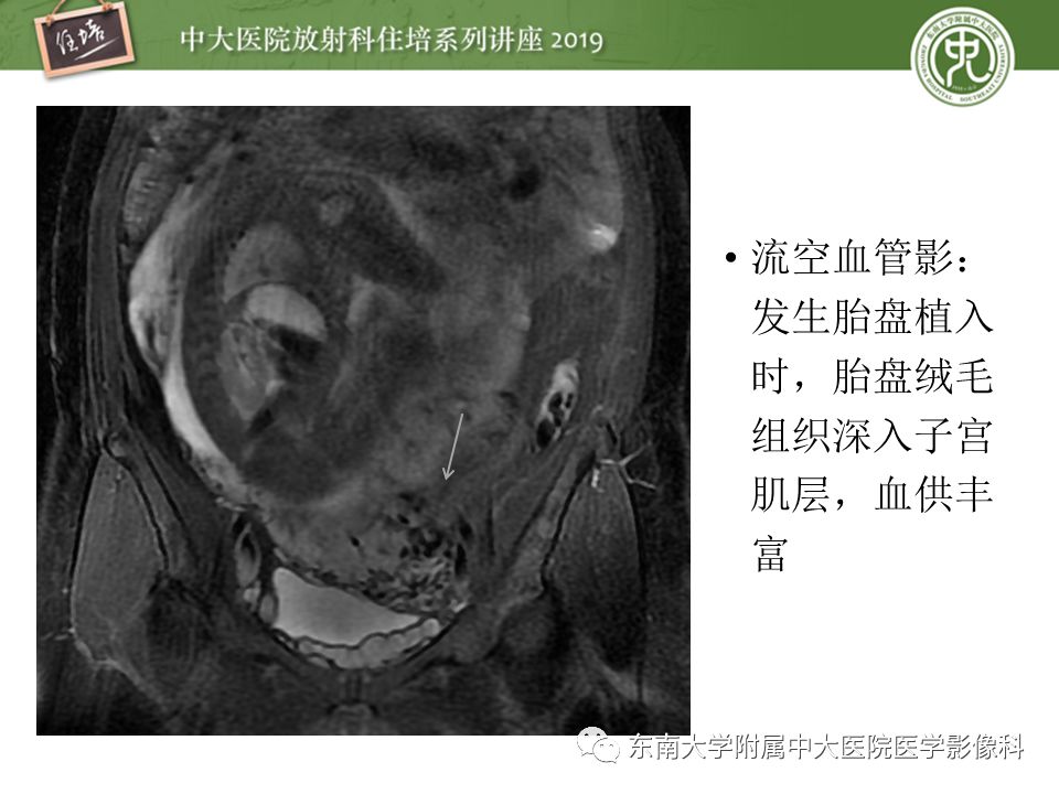 【PPT】胎盘相关MR诊断