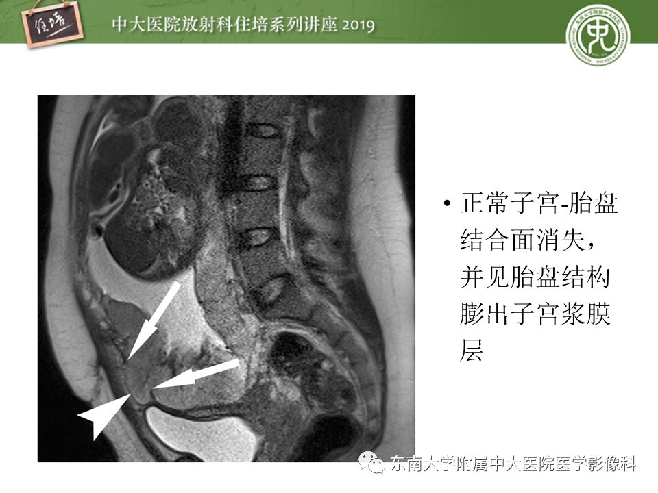 【PPT】胎盘相关MR诊断