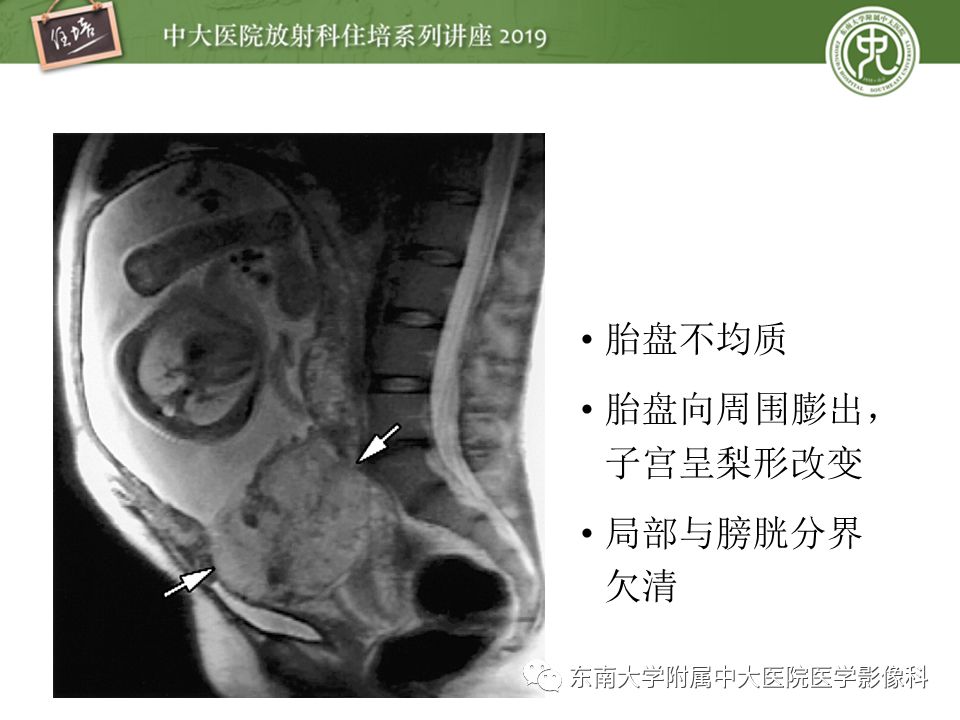 【PPT】胎盘相关MR诊断