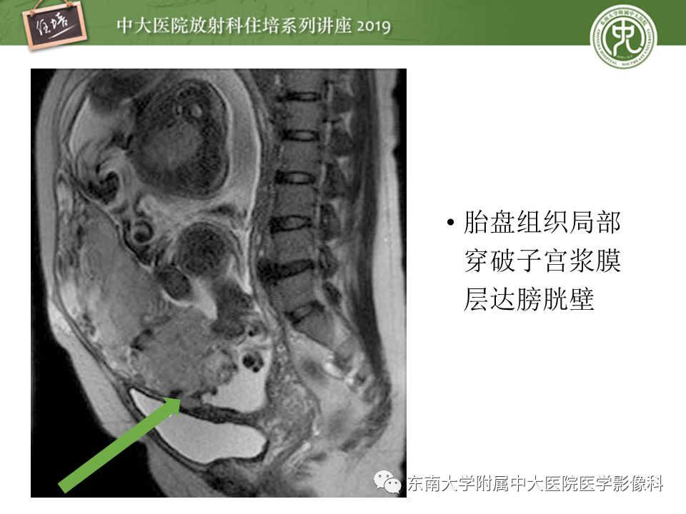 【PPT】胎盘相关MR诊断