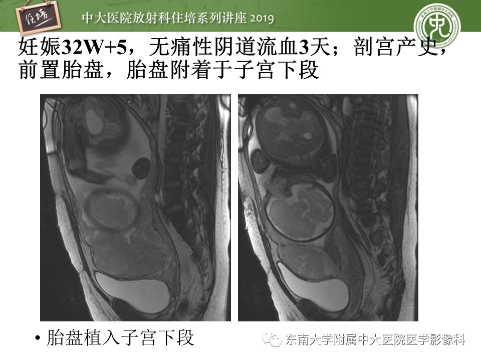 【PPT】胎盘相关MR诊断