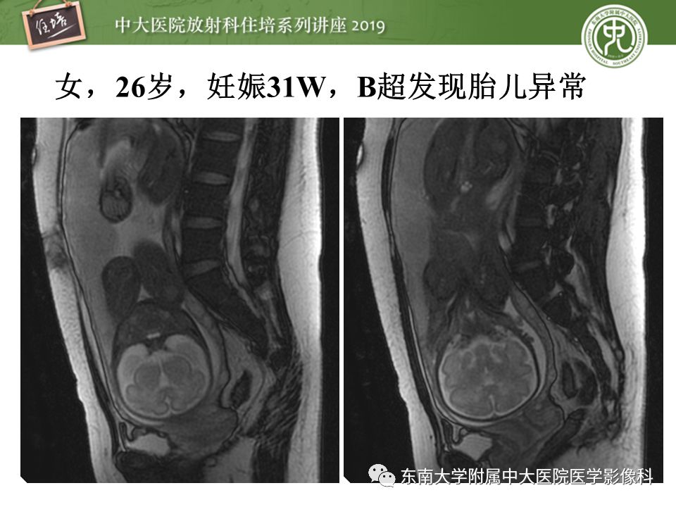 【PPT】胎盘相关MR诊断