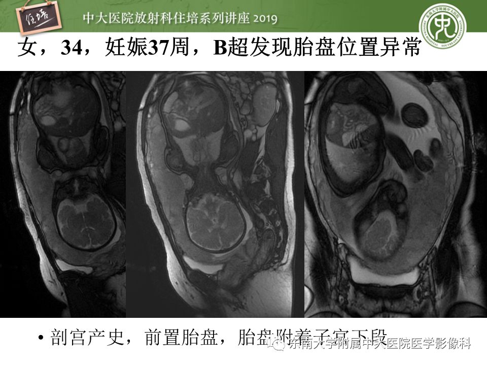 【PPT】胎盘相关MR诊断