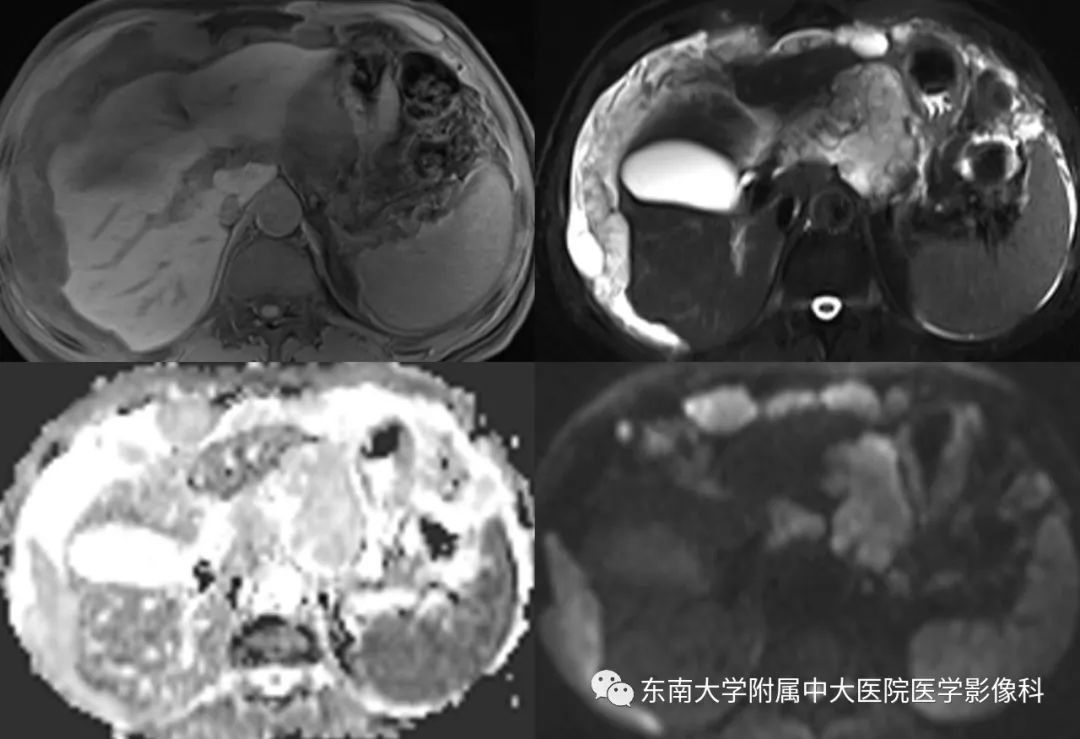 【病例】腹膜假性粘液瘤1例MR及PET-CT