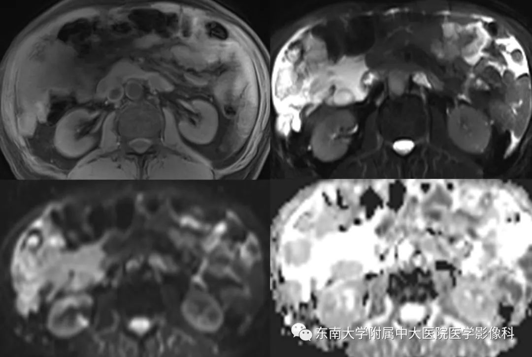 【病例】腹膜假性粘液瘤1例MR及PET-CT