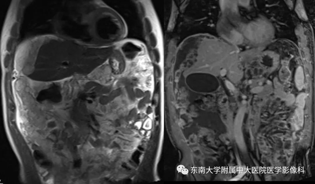 【病例】腹膜假性粘液瘤1例MR及PET-CT