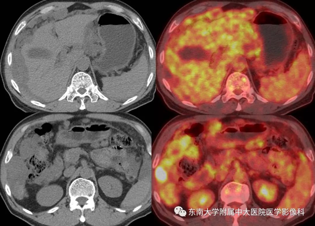 【病例】腹膜假性粘液瘤1例MR及PET-CT
