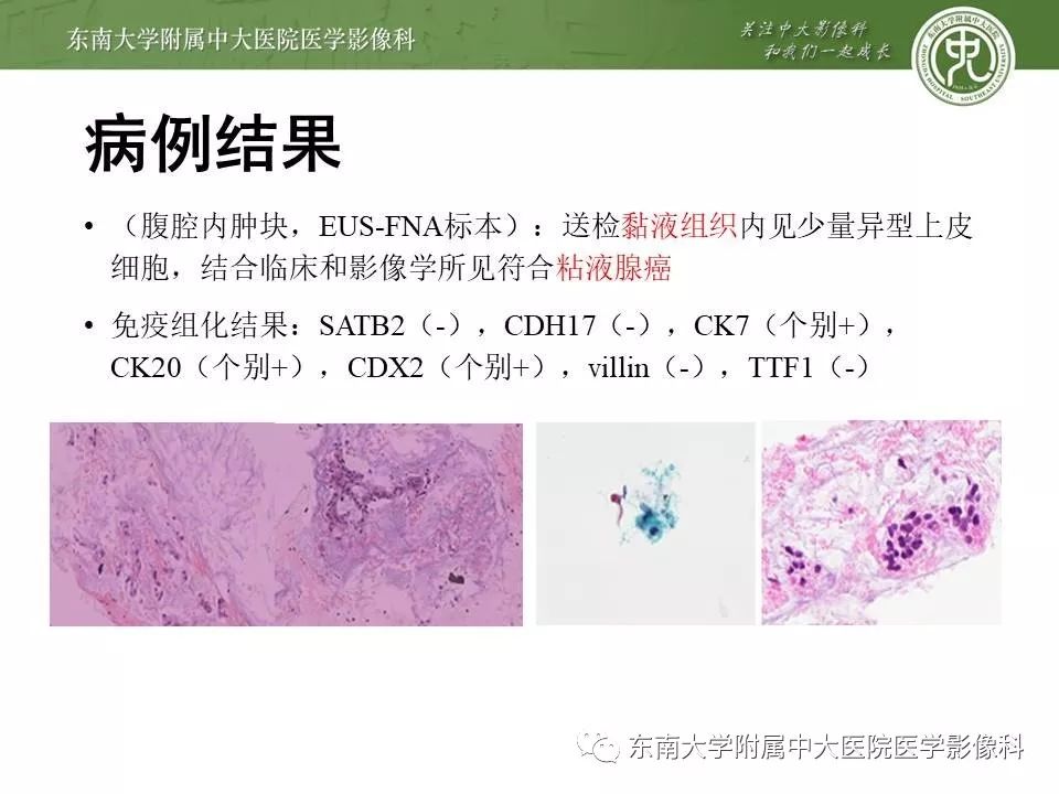 【病例】腹膜假性粘液瘤1例MR及PET-CT