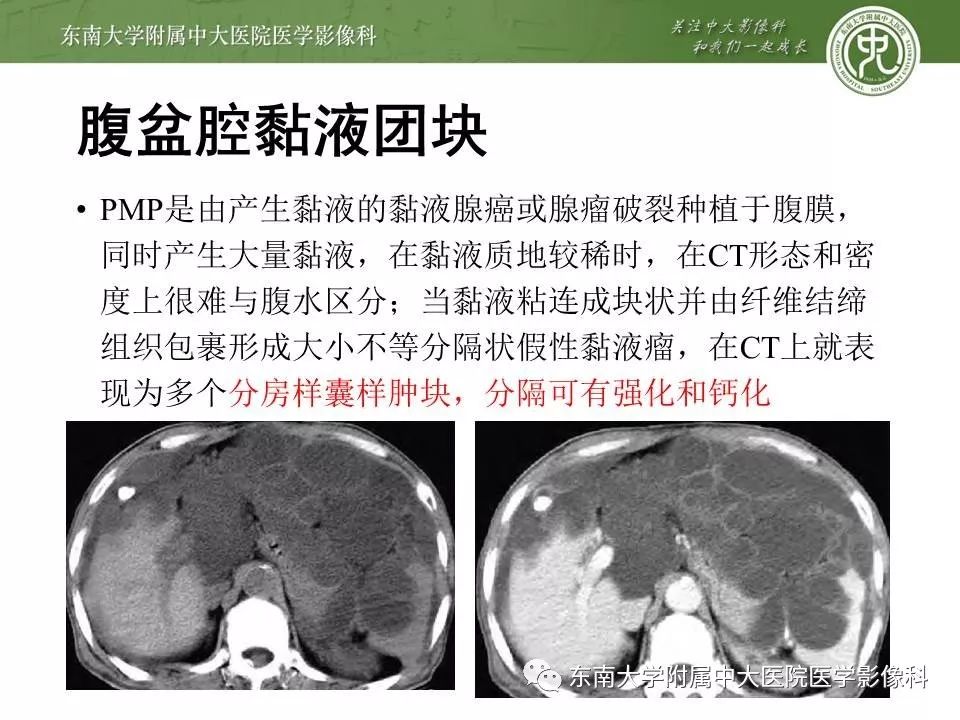 【病例】腹膜假性粘液瘤1例MR及PET-CT
