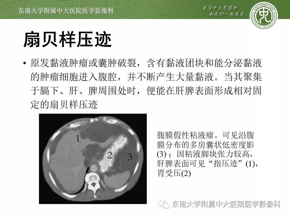 【病例】腹膜假性粘液瘤1例MR及PET-CT