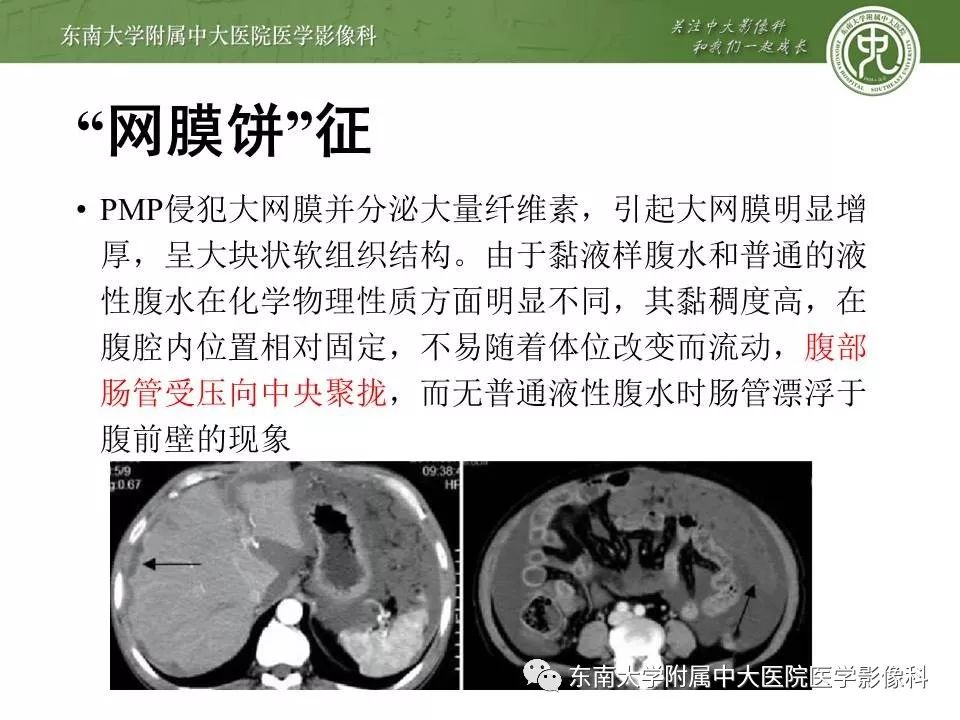 【病例】腹膜假性粘液瘤1例MR及PET-CT