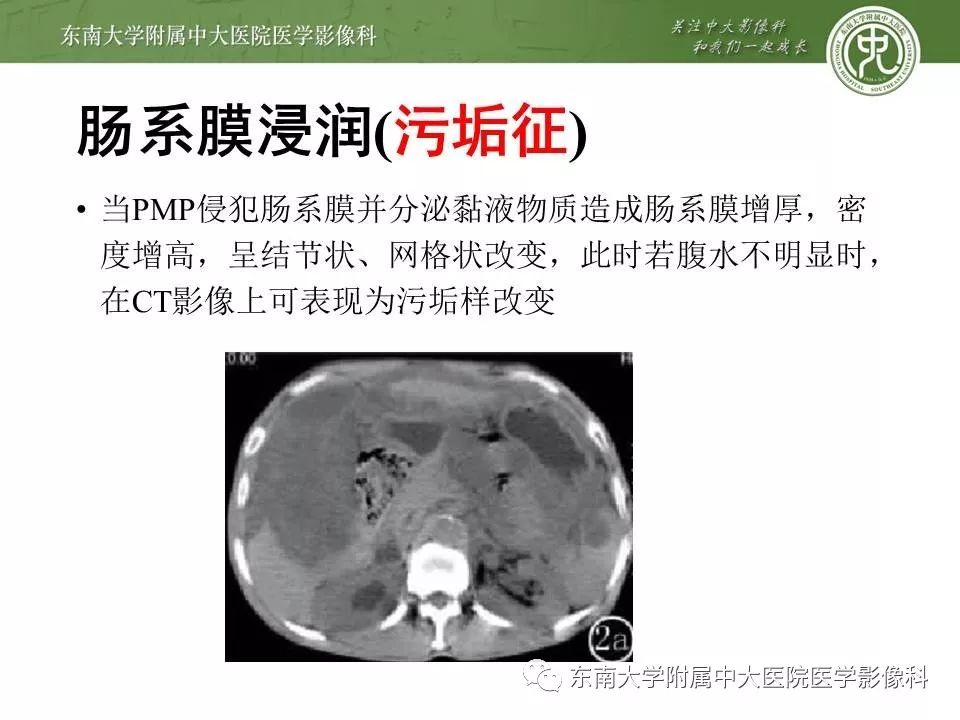 【病例】腹膜假性粘液瘤1例MR及PET-CT