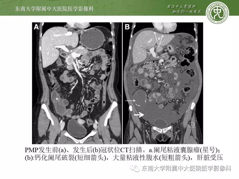 【病例】腹膜假性粘液瘤1例MR及PET-CT