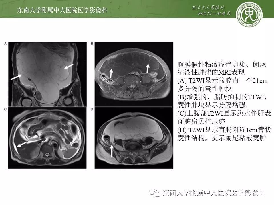 【病例】腹膜假性粘液瘤1例MR及PET-CT
