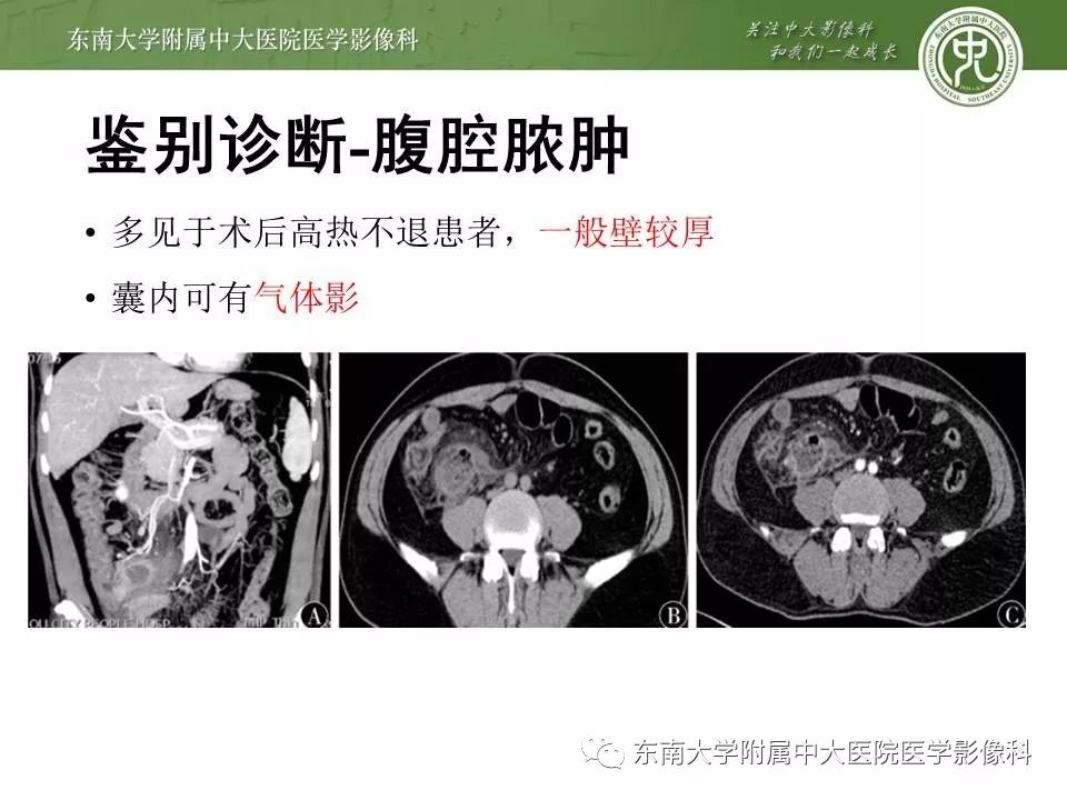 【病例】腹膜假性粘液瘤1例MR及PET-CT