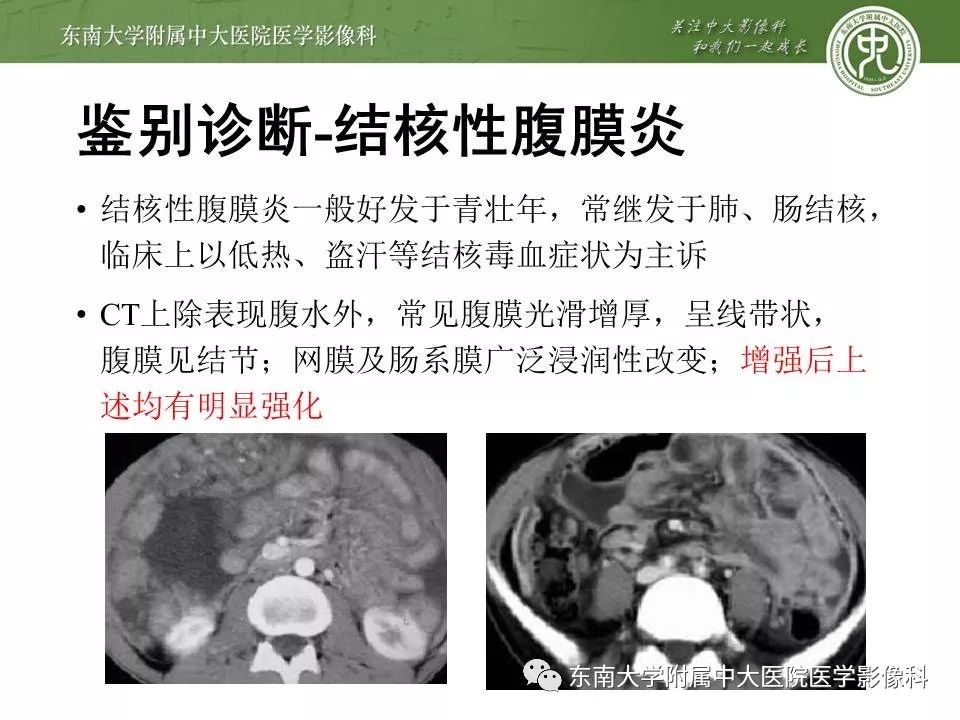 【病例】腹膜假性粘液瘤1例MR及PET-CT