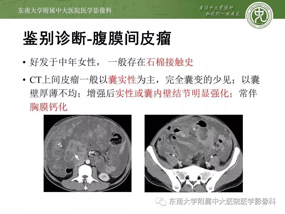 【病例】腹膜假性粘液瘤1例MR及PET-CT