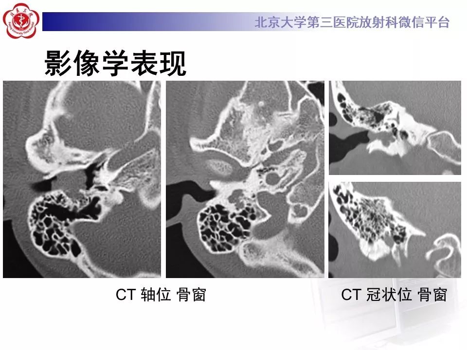 【病例】面神经鞘瘤1例CT及MR影像