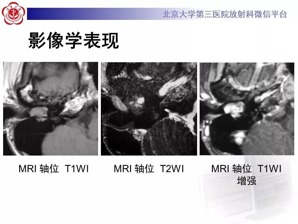 【病例】面神经鞘瘤1例CT及MR影像